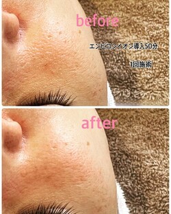 エンビロンイオン導入50分|肌質改善エステサロン Amaryllis池袋店