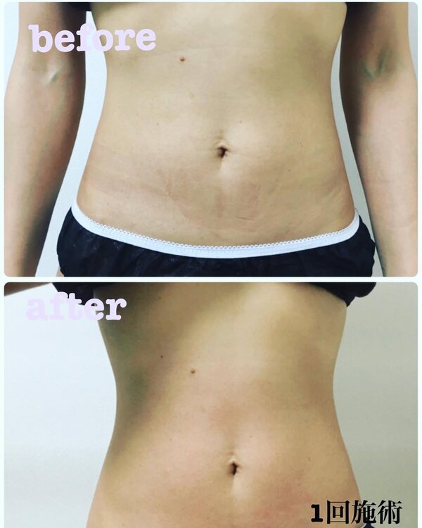 キャビ✖ラジオ波✖ハンド120分|肌質改善エステサロン Amaryllis池袋店