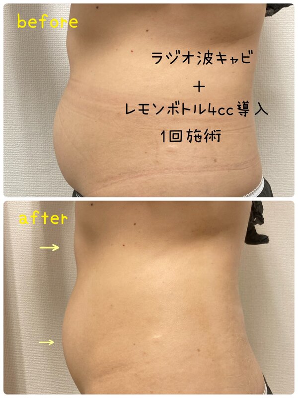 完全オーガニック脂肪溶解剤レモンボトル|肌質改善エステサロン Amaryllis池袋店