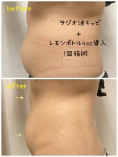 完全オーガニック脂肪溶解剤レモンボトル|肌質改善エステサロン Amaryllis池袋店