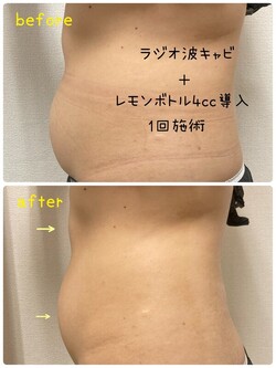 完全オーガニック脂肪溶解剤レモンボトル|肌質改善エステサロン Amaryllis池袋店