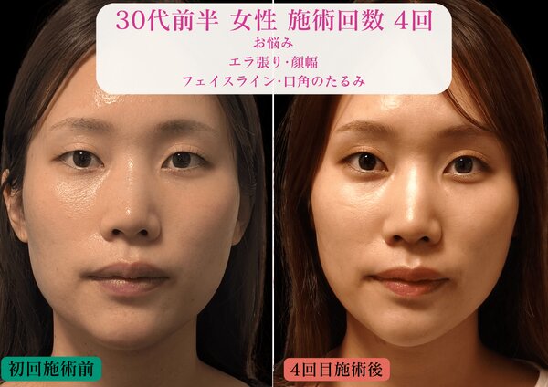 【食いしばりによるエラ張り・たるみ】原因から整える小顔美容鍼+LED|美容とカラダの鍼灸サロン やなけん 亀戸店