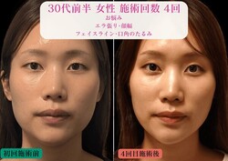 【食いしばりによるエラ張り・たるみ】原因から整える小顔美容鍼+LED|美容とカラダの鍼灸サロン やなけん 亀戸店