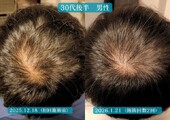 【抜け毛が増えた／頭皮が透けて見える方に】育毛促進鍼＋LED|美容とカラダの鍼灸サロン やなけん 亀戸店