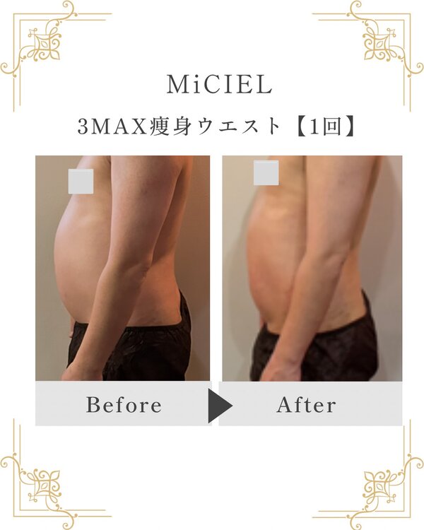 3MAX痩身ウエスト【1回】　|トータルビューティサロンMiCIEL