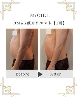 3MAX痩身ウエスト【1回】　|トータルビューティサロンMiCIEL