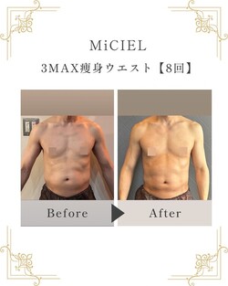 3MAX痩身ウエスト【8回】|トータルビューティサロンMiCIEL