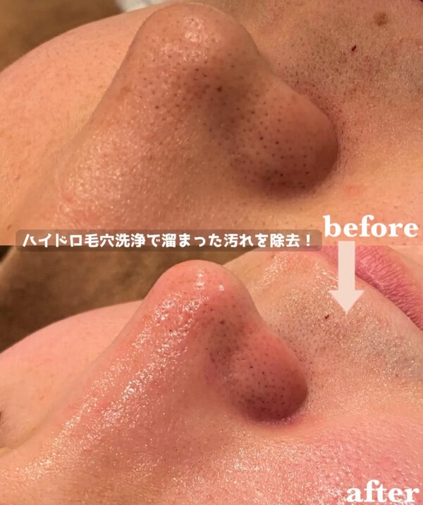 【Before / After】ハイドロ毛穴洗浄|Luana　BEAUTY　SALON