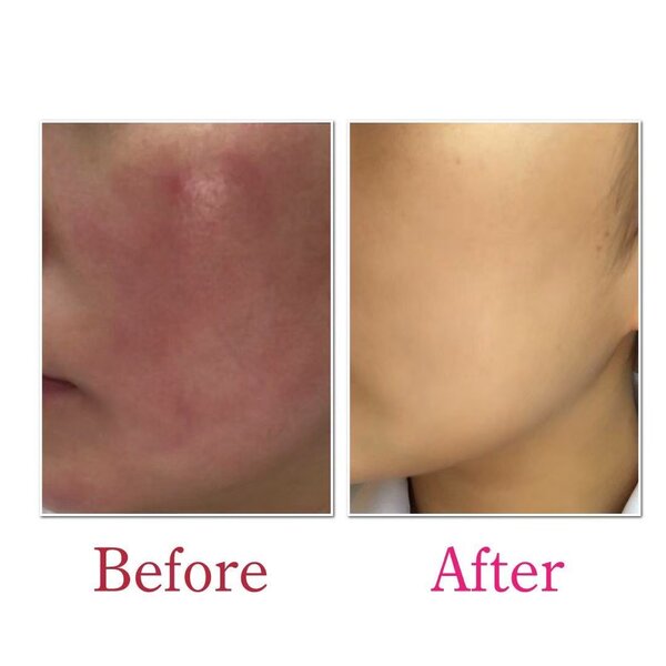 【Before / After】REVI陶肌トリートメント|Luana　BEAUTY　SALON