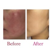 【Before / After】REVI陶肌トリートメント|Luana　BEAUTY　SALON