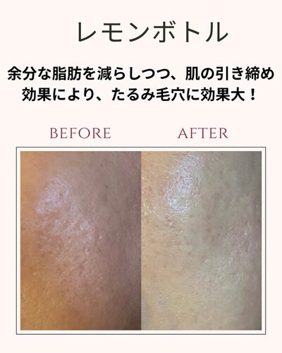 レモンボトルフェイシャル