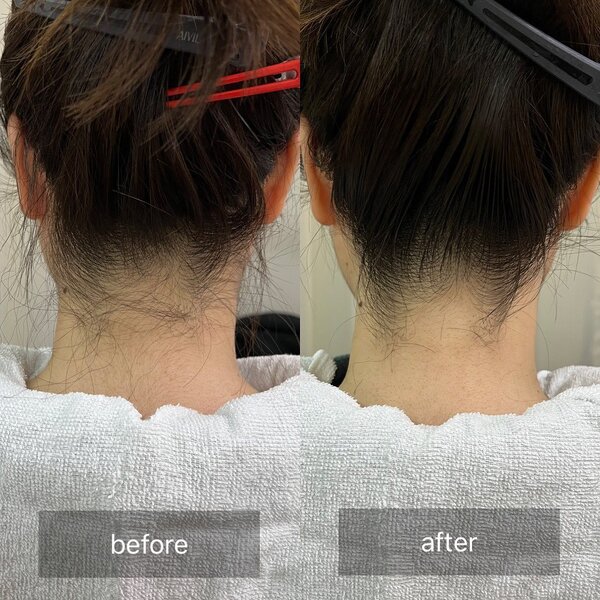 うなじ脱毛|Beauty salon Ivy