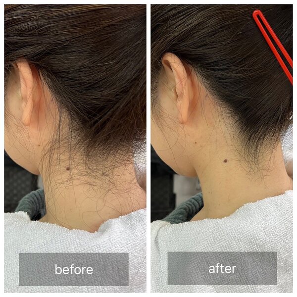 うなじ脱毛|Beauty salon Ivy