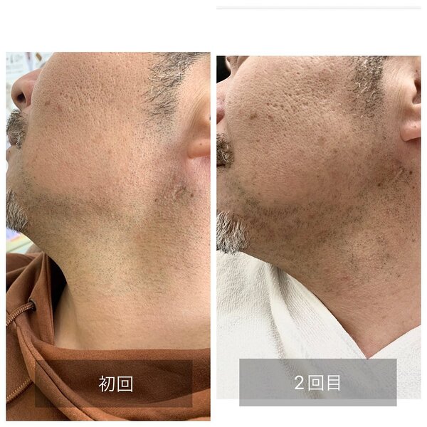 メンズ脱毛（ひげ脱毛）①|Beauty salon Ivy