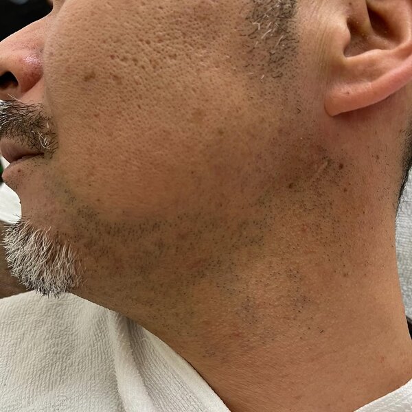 メンズ脱毛（ひげ脱毛）①|Beauty salon Ivy