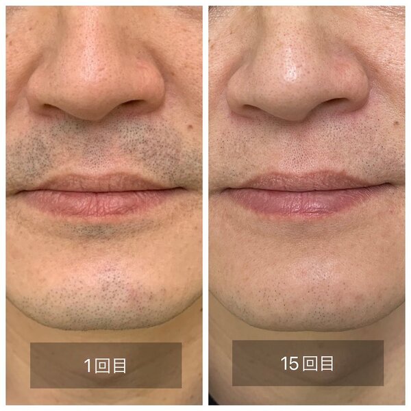 メンズ脱毛（ひげ脱毛）②|Beauty salon Ivy