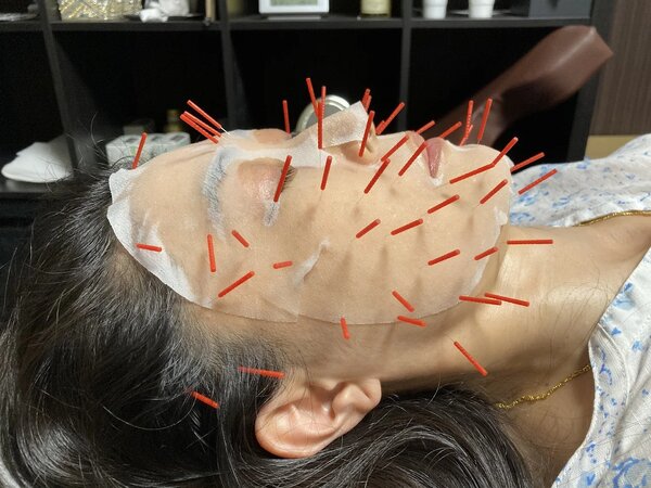 幹細胞美容鍼®|アキュモ整体院