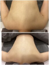 背中つるすべトリートメント|医療提携エステティックサロン　痩身専門Soin