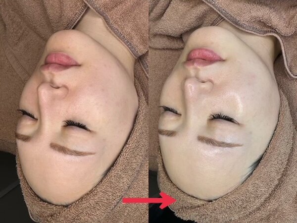 ララピール≪Before⇔After≫①|naturax　恵比寿店