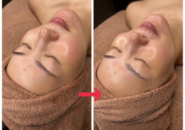 ララピール≪Before⇔After≫②|naturax　恵比寿店