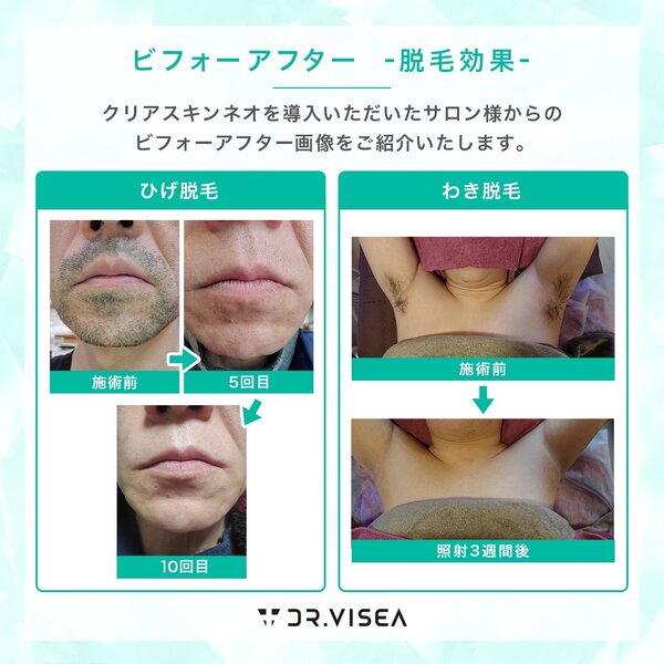IPLで髭脱毛|GreeNya