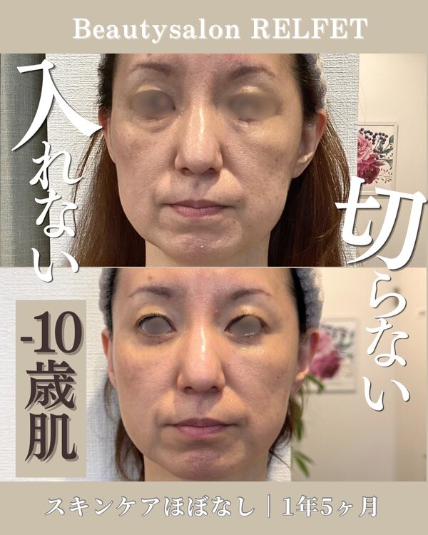 乾燥も、たるみも気になる方へ|Beautysalon REFLET