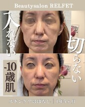乾燥も、たるみも気になる方へ|Beautysalon REFLET