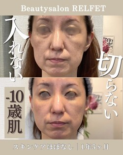 乾燥も、たるみも気になる方へ|Beautysalon REFLET