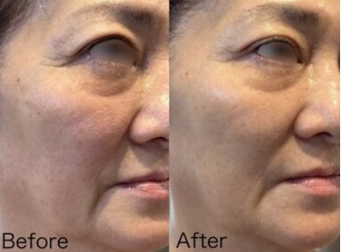 Before/After シワ|Beautysalon REFLET