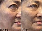 Before/After シワ|Beautysalon REFLET