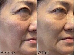 Before/After シワ|Beautysalon REFLET