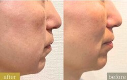 Before/After 毛穴洗浄|Beautysalon REFLET
