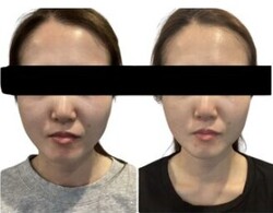 Before/After乾燥肌|Beautysalon REFLET