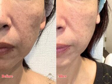 Before/Afterたるみ|Beautysalon REFLET