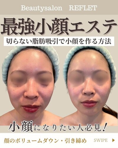 最強小顔エステ