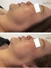 小顔フェイシャル|医療提携エステティックサロン　痩身専門Soin