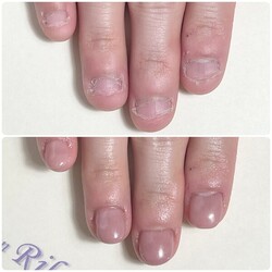 深爪矯正　初回の長さ出し|Nail  Salon Rikka