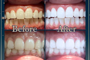 【Whi-Ya(ホワイヤ)】セルフホワイトニングDBS神楽坂 | 飯田橋のエステサロン