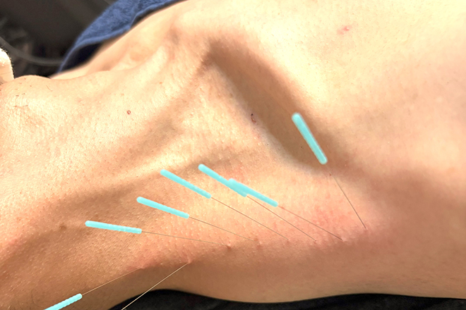 首こり肩こり腰痛自律神経 トリガーポイント広島とだ鍼灸院 | 八丁堀/白島/牛田のリラクゼーション