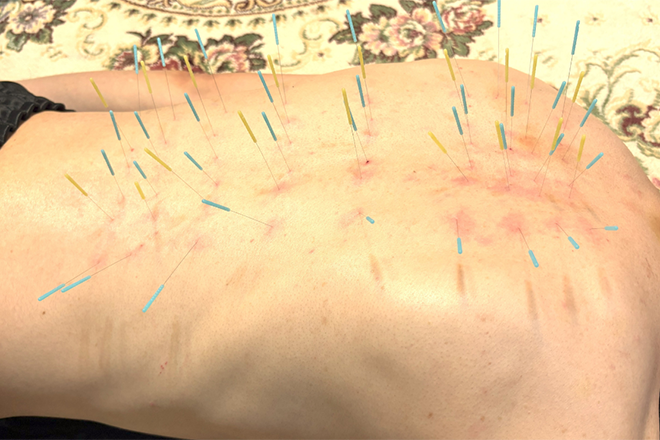 首こり肩こり腰痛自律神経 トリガーポイント広島とだ鍼灸院 | 八丁堀/白島/牛田のリラクゼーション