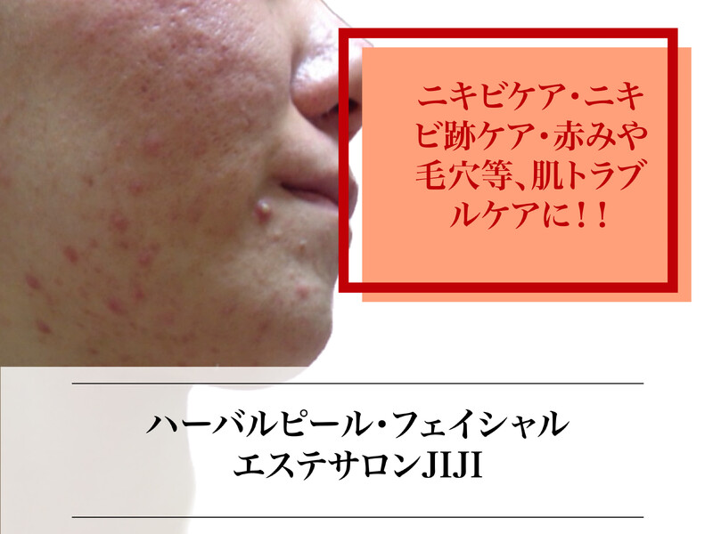 ハーバルピール・フェイシャル専門 エステサロンJIJI新宿 | 新宿のエステサロン