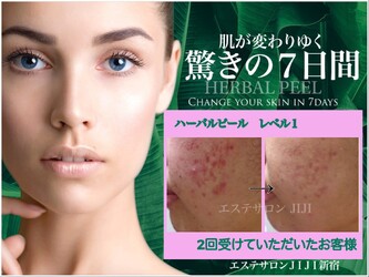 ハーバルピール・フェイシャル専門 エステサロンJIJI新宿 | 新宿のエステサロン