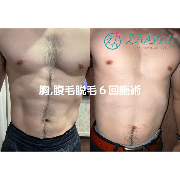 脱毛サロン enmusubi | 山陽小野田のエステサロン