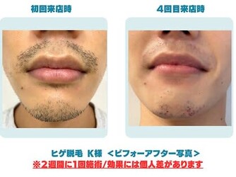 メンズ脱毛NEXT+梅田店 | 梅田のエステサロン