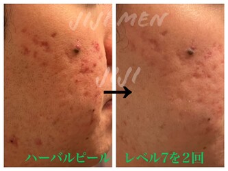 ハーバルピール・フェイシャル/ヘッド専門 エステティックサロンJ IJ I M E N | 新宿のエステサロン