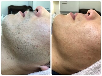 メンズ脱毛スキンケア GOLD PLUS 小牧店 | 小牧のエステサロン