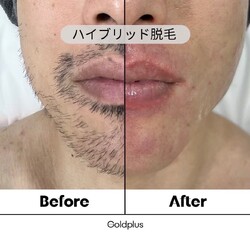 美肌脱毛専門店 Pearl plus 新倉敷店 | 倉敷のエステサロン