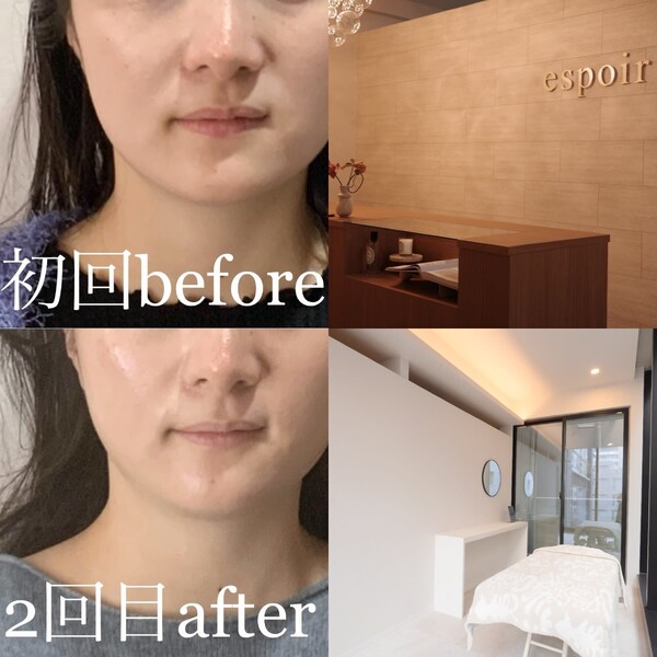 小顔・肌質改善サロンespoir ハーブピーリング/毛穴 | 心斎橋のエステサロン