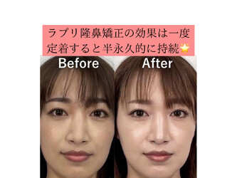隆鼻矯正専門店 Raplit 福岡博多店 | 博多のエステサロン 隆鼻矯正専門店 Raplit 福岡博多店 | 博多のエステサロン