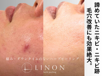 ハーブピーリング専門店LINON | 香芝のエステサロン ハーブピーリング専門店LINON | 香芝のエステサロン